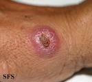 leishmaniasis-cutaneous leishmaniasis