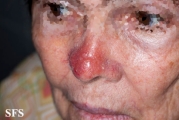 leishmaniasis-cutaneous leishmaniasis