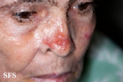 leishmaniasis-cutaneous leishmaniasis