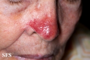 leishmaniasis-cutaneous leishmaniasis