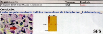 leishmaniasis-cutaneous leishmaniasis