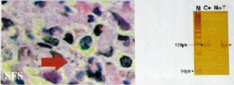 leishmaniasis-cutaneous leishmaniasis