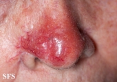 leishmaniasis-cutaneous leishmaniasis