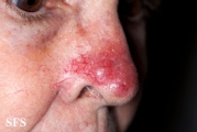 leishmaniasis-cutaneous leishmaniasis
