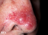 leishmaniasis-cutaneous leishmaniasis