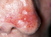 leishmaniasis-cutaneous leishmaniasis