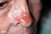 leishmaniasis-cutaneous leishmaniasis
