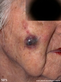 malignant peripheral nerve sheath tumors