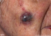 malignant peripheral nerve sheath tumors