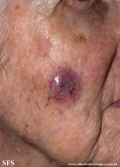 malignant peripheral nerve sheath tumors
