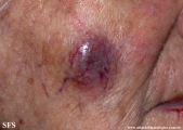 malignant peripheral nerve sheath tumors