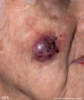 malignant peripheral nerve sheath tumors
