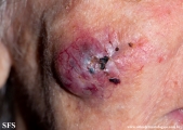 malignant peripheral nerve sheath tumors