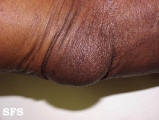 cyst synovial