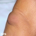 cyst synovial