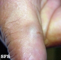 cyst synovial