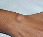 cyst synovial