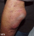 cyst synovial