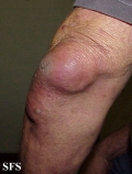 cyst synovial