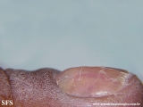 glomus tumor