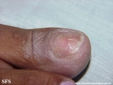 glomus tumor