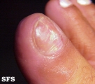 glomus tumor