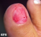 glomus tumor