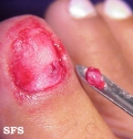 glomus tumor