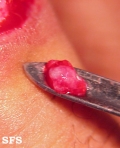 glomus tumor