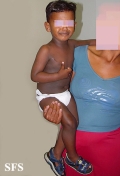 dyschromatosis universalis