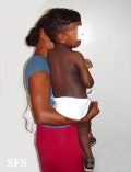 dyschromatosis universalis