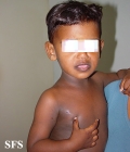 dyschromatosis universalis