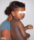 dyschromatosis universalis