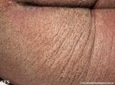 norwegian scabies