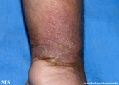 norwegian scabies