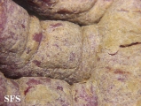 norwegian scabies