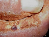 norwegian scabies