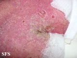 norwegian scabies