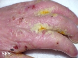 norwegian scabies