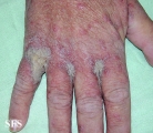 norwegian scabies