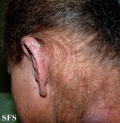 norwegian scabies
