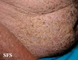 norwegian scabies