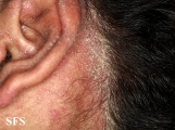 norwegian scabies