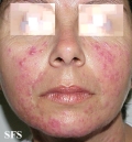 acne rosacea