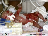 harlequim ichthyosis