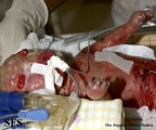 harlequim ichthyosis