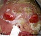 harlequim ichthyosis