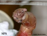 harlequim ichthyosis