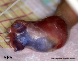 harlequim ichthyosis