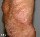 wells' syndrome